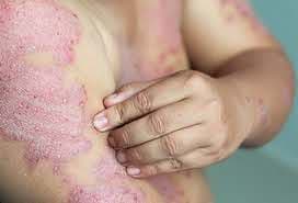 Skin Diseases
